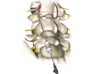 Radiofrequency Rhizotomy- Neurotomy