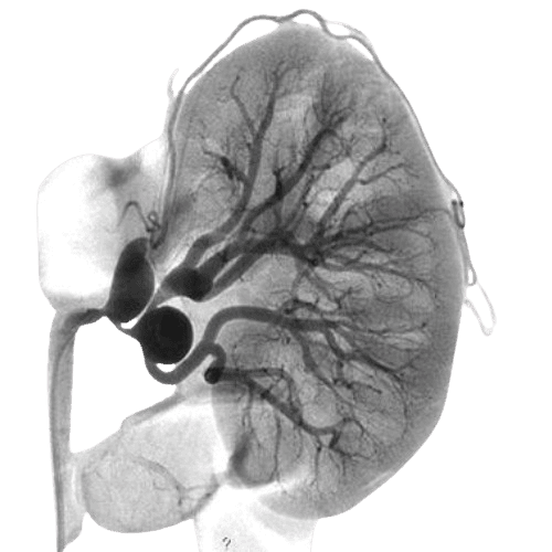 Renal Angiogram