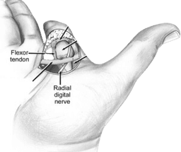 Repair of Digital Nerves