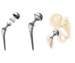 Revision Hip Replacement