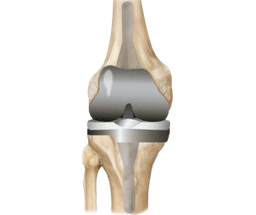 Revision Knee Replacement