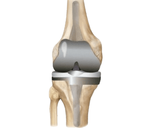 Revision Knee Replacement