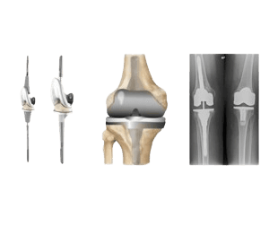 Revision Single Knee Replacement