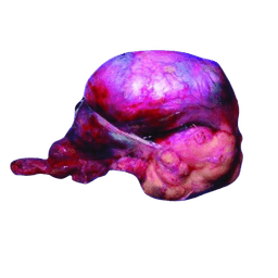 Rhabdomyosarcoma-RMS