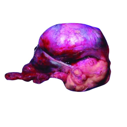 Rhabdomyosarcoma-RMS