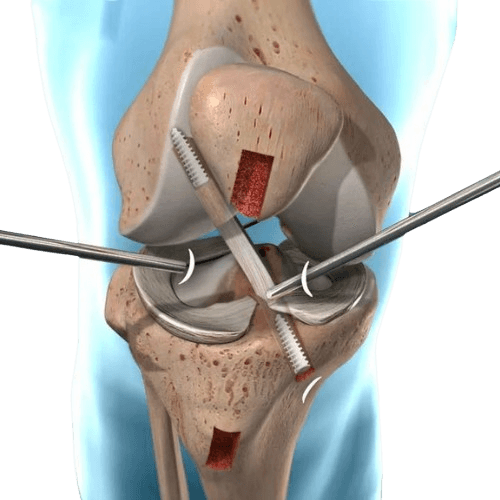 Robotic ACL Reconstruction in India