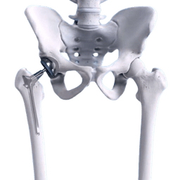 Robotic Bilateral Hip Replacement Surgery