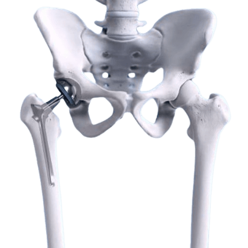 Robotic Bilateral Hip Replacement Surgery