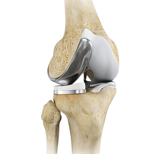 Robotic Bilateral Knee Replacement Surgery
