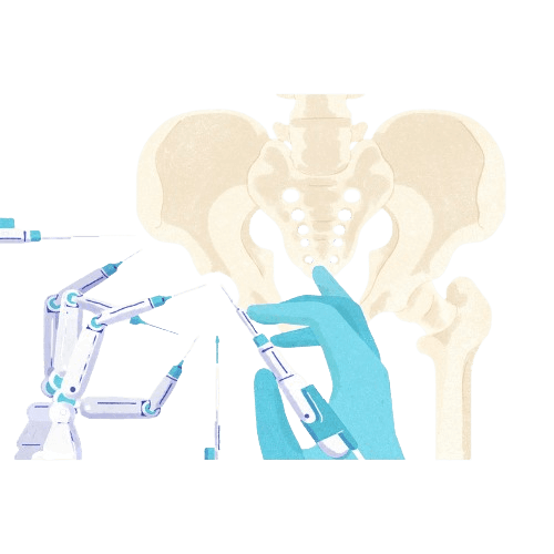 Robotic Hip Replacement Surgery