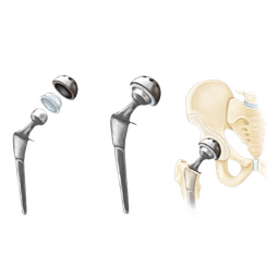 Robotic Partial Hip Replacement Surgery - Unilateral Hip Replacement