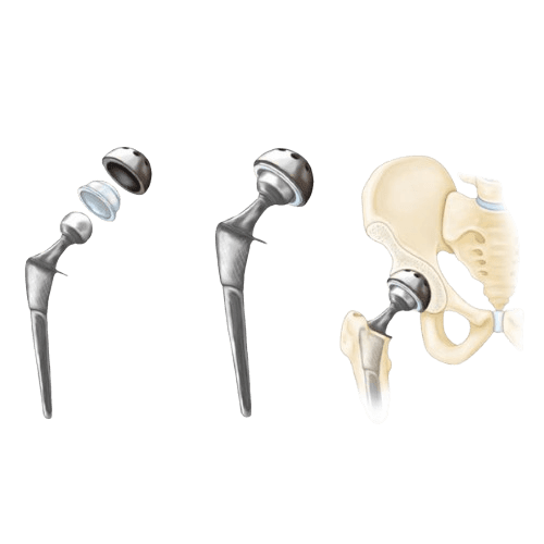 Robotic Partial Hip Replacement Surgery - Unilateral Hip Replacement