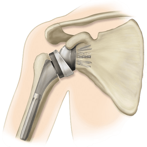 Robotic Shoulder Replacement Surgery
