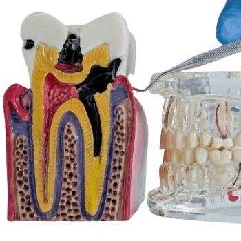 Root Canal