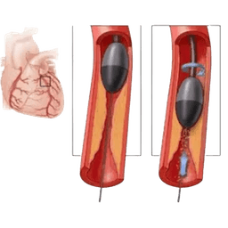 Rotablation Guided Stenting