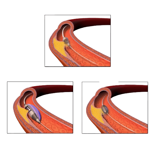 Rotational Atherectomy