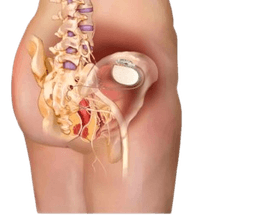 Sacral Nerve Stimulation-SNS