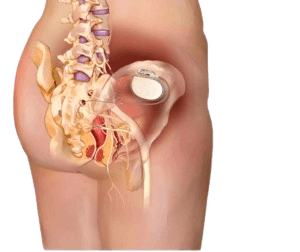 Sacral Nerve Stimulation-SNS