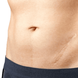 Scar Removal