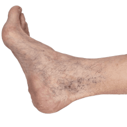 Sclerotherapy - Spider Vein