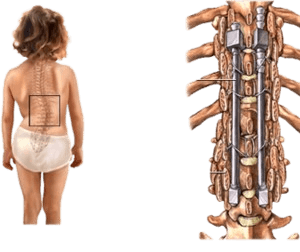 Scoliosis Spine Surgery