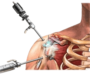 Shoulder Arthroscopy