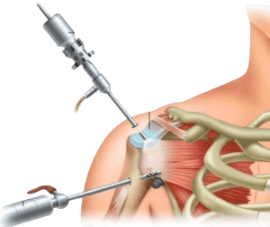 Shoulder Labral Tear Surgery (Arthroscopic Labrum Repair)