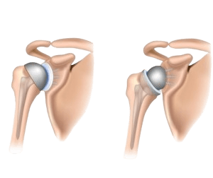 Shoulder Replacement Surgery