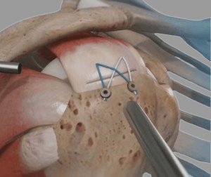 Shoulder Rotator Cuff Repair