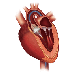 Single Bypass & Valve Replacement Surgery