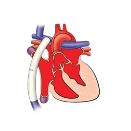 Single Ventricle Defects Surgery