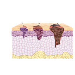 Skin Cancer - Melanoma