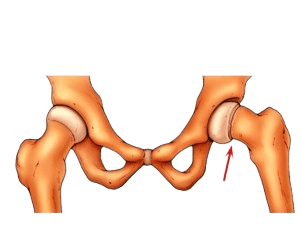 Slipped Capital Femoral Epiphysis-SCFE