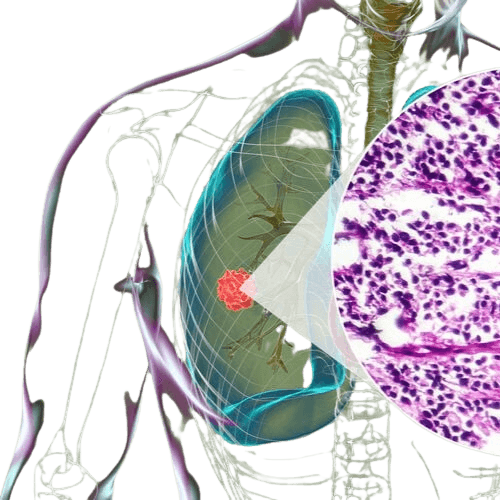 Small Cell Carcinoma