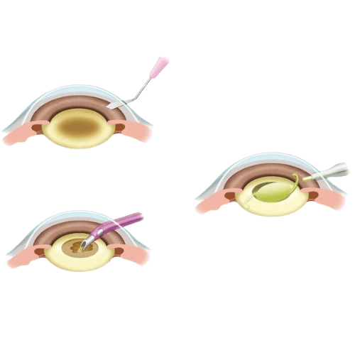 Small Incision Cataract Surgery (SICS)