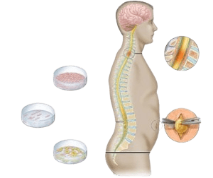 Spinal Cord Injury- Stem Cell