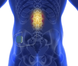 Spinal Cord Stimulator