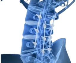 Spinal Decompression & Fusion