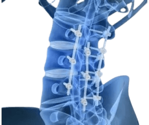 Spinal Decompression & Fusion