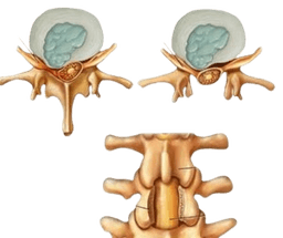 Spinal Decompression Surgery