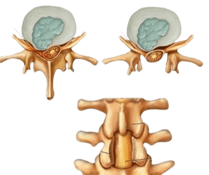 Spinal Decompression Surgery