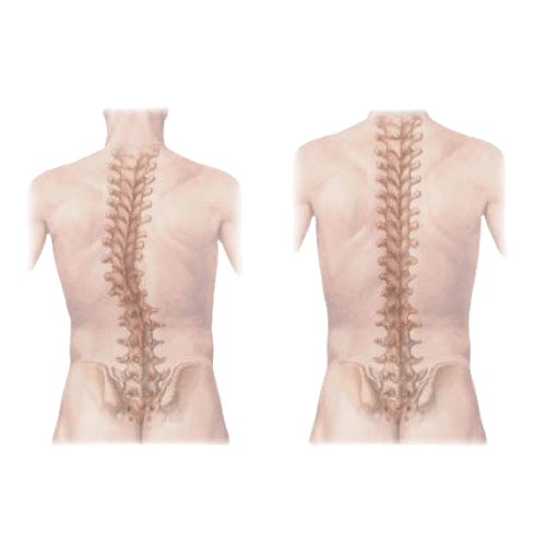 Spinal Deformity Correction Surgery