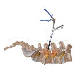 Spinal Endoscopic Surgery