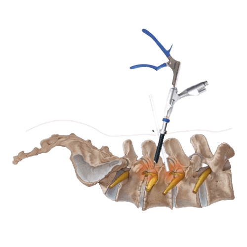 Spinal Endoscopic Surgery