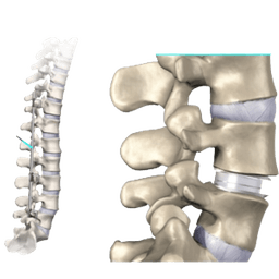 Spinal Instrumentation