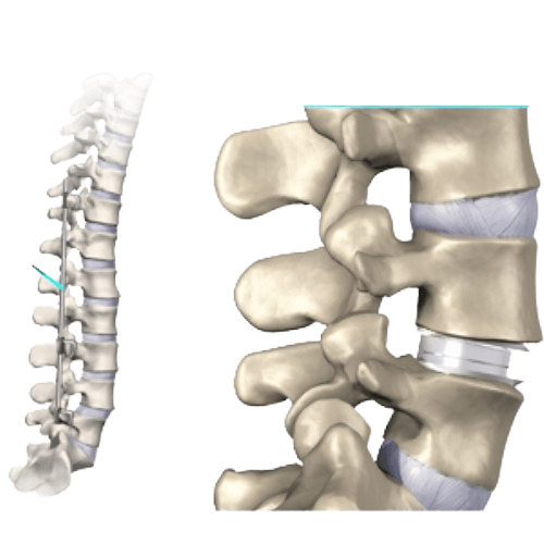 Spinal Instrumentation