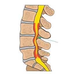Spinal Stenosis