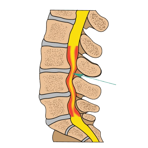Spinal Stenosis