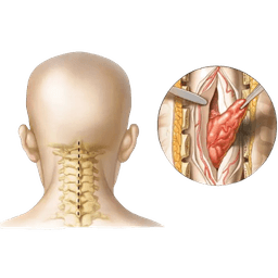 Spine Tumor Surgery