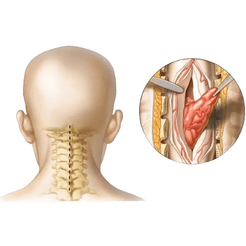 Spine Tumor Surgery